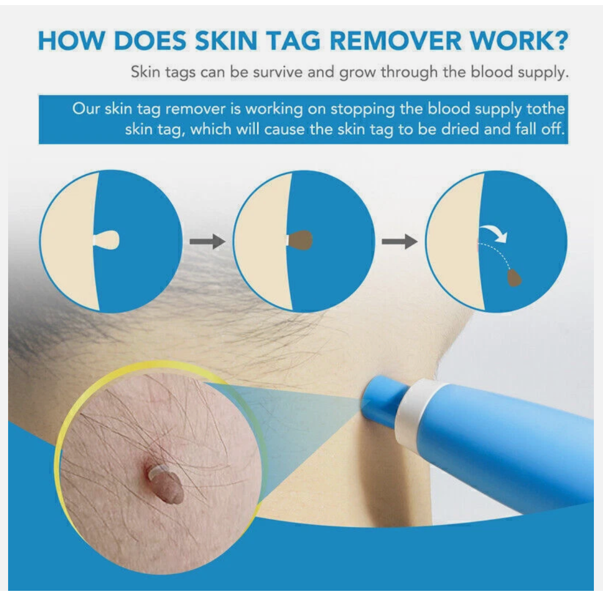 Painless Skin Tag Mole Wart Removal Kit, Body Auto SKIN TAG Bands Remover Safe