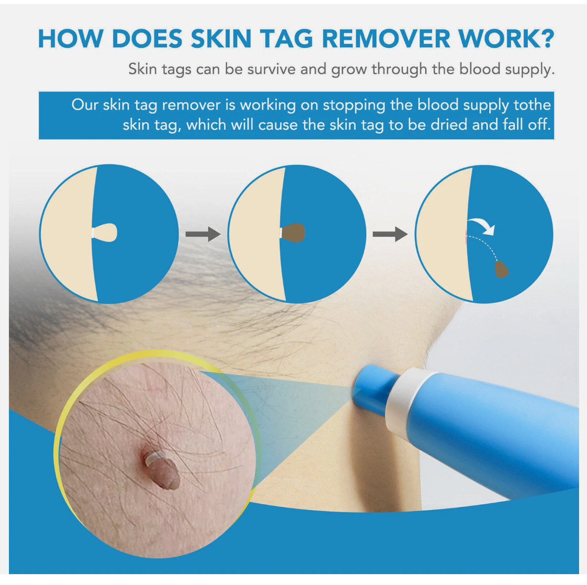 Painless Skin Tag Mole Wart Removal Kit, Body Auto SKIN TAG Bands Remover Safe