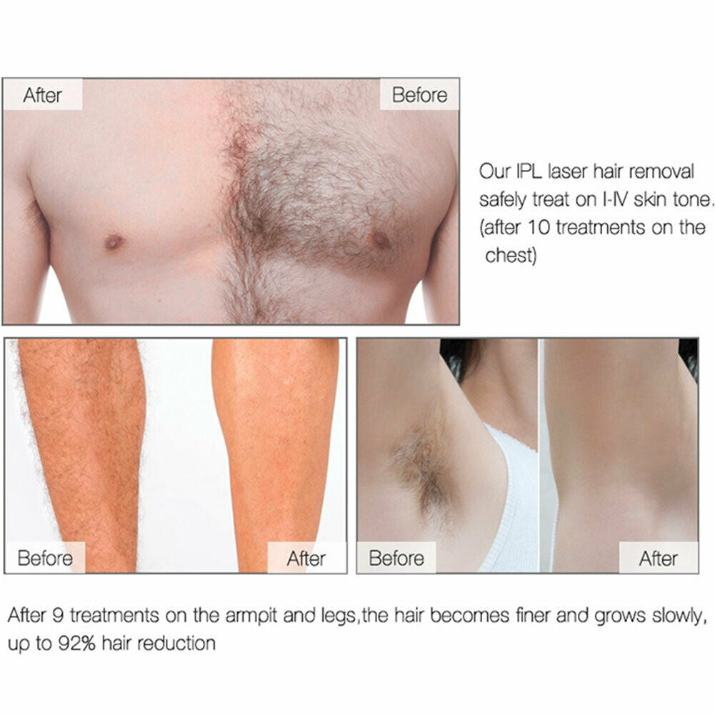 Laser Hair Remover